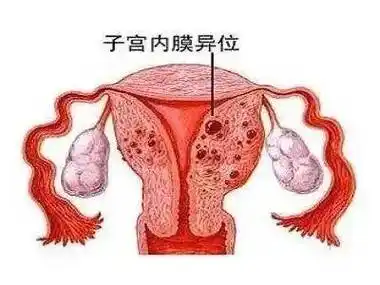 子宫内膜异位症为什么会引发不孕？